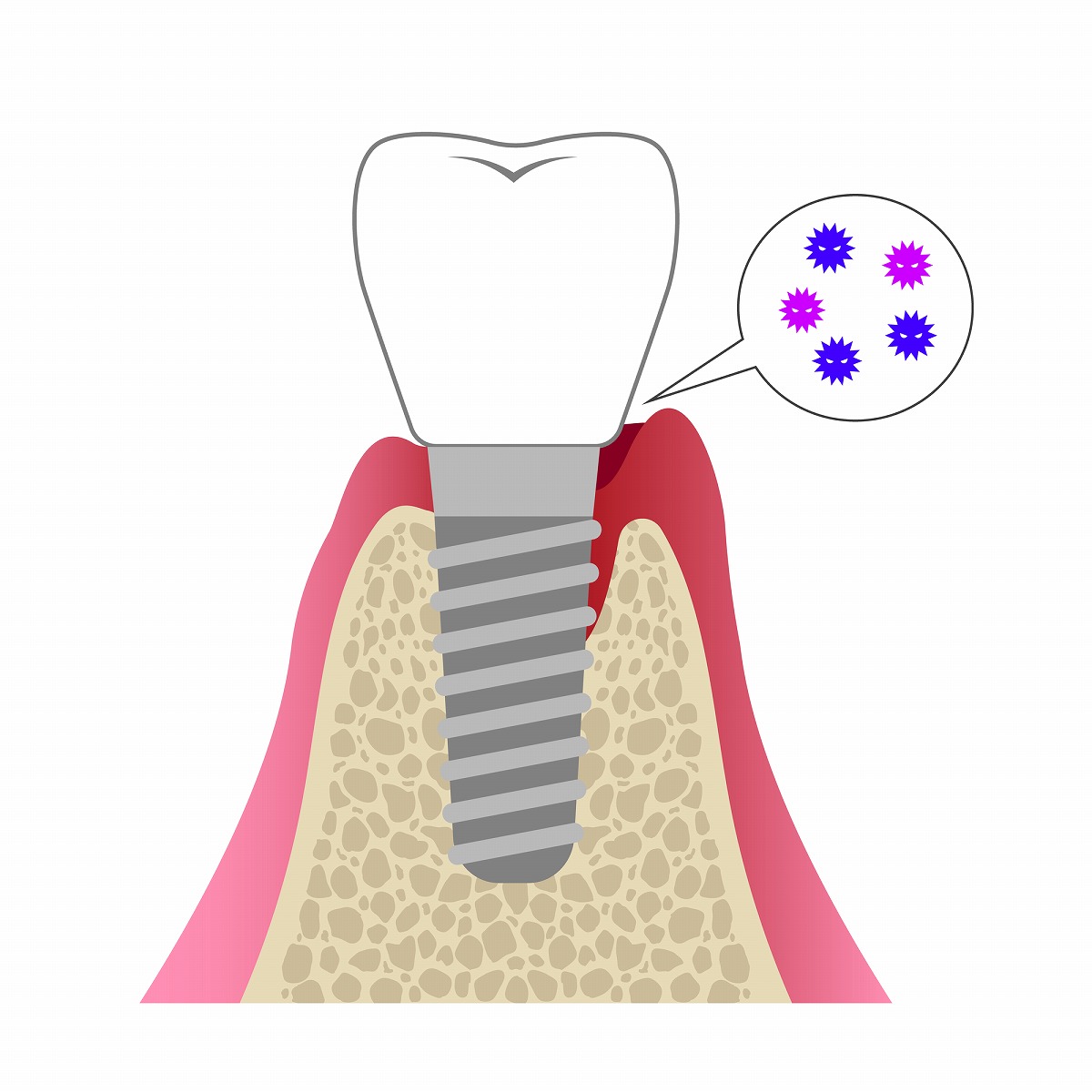 インプラント周囲炎とは?