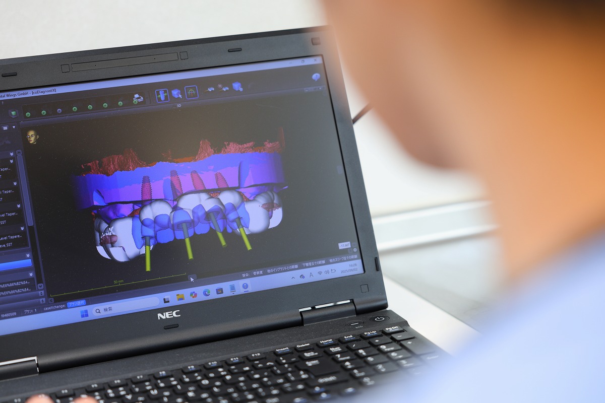 サージカルガイドについて