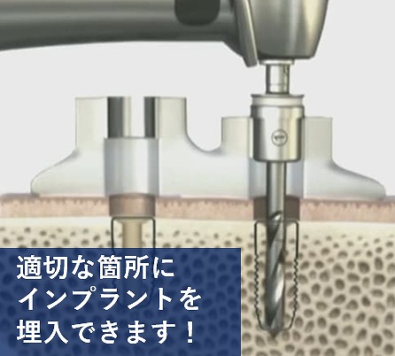 インプラント治療のサージカルガイドとは?